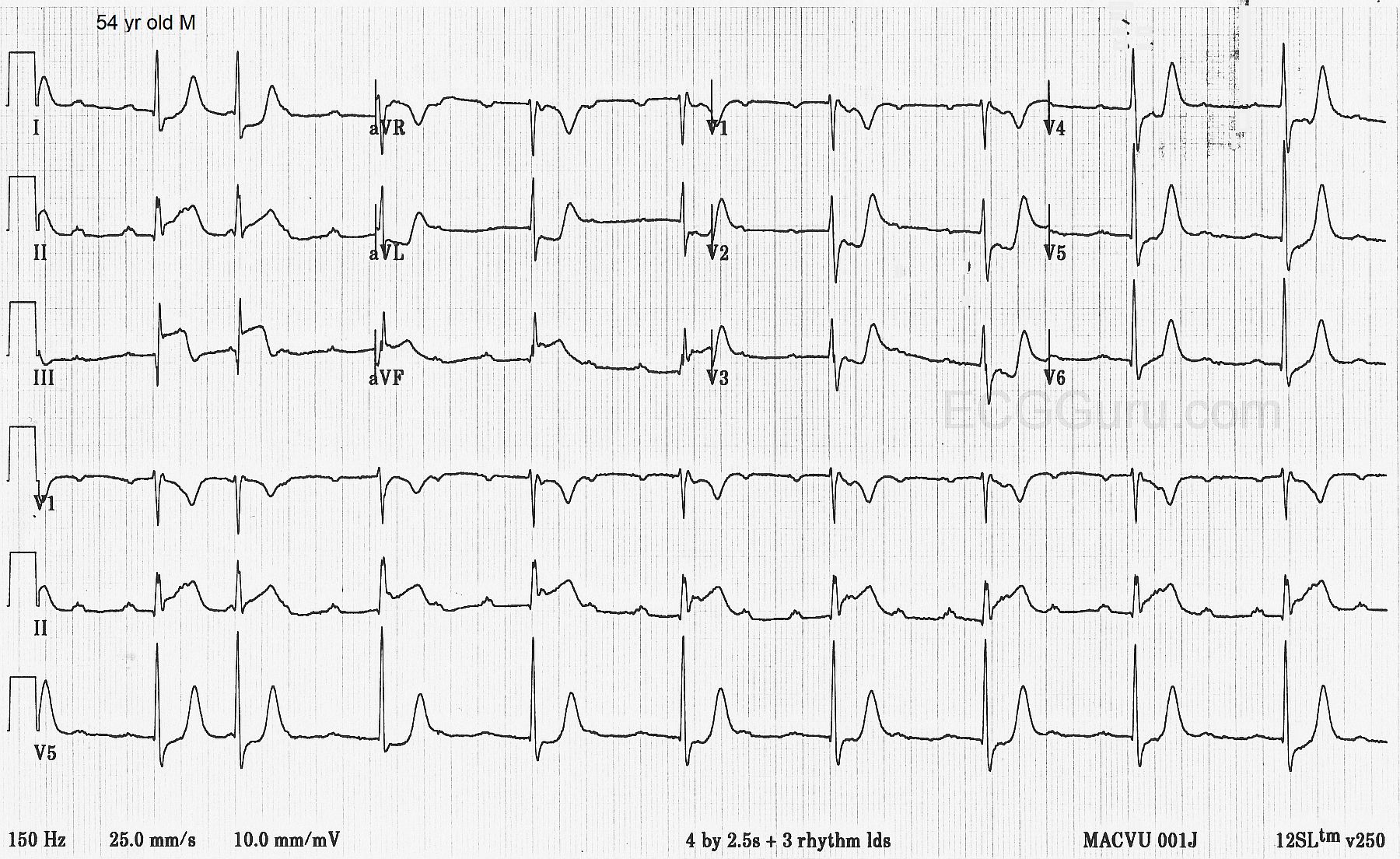 third-degree-av-block-ecg-guru-instructor-resources